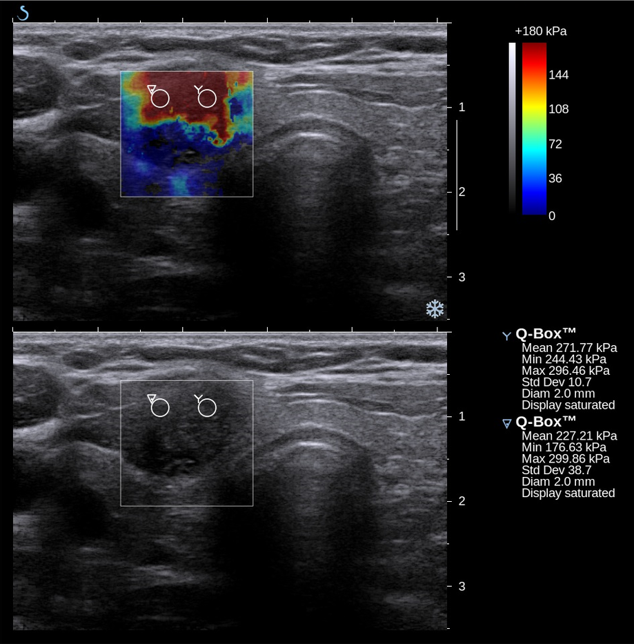 Shearwave Elastography