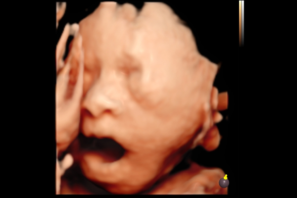 4D Ultrasound